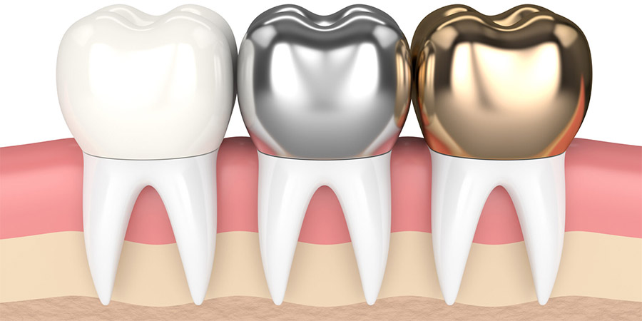 Types d'implants dentaires